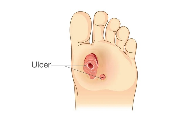 Diabetic Foot Ulcers